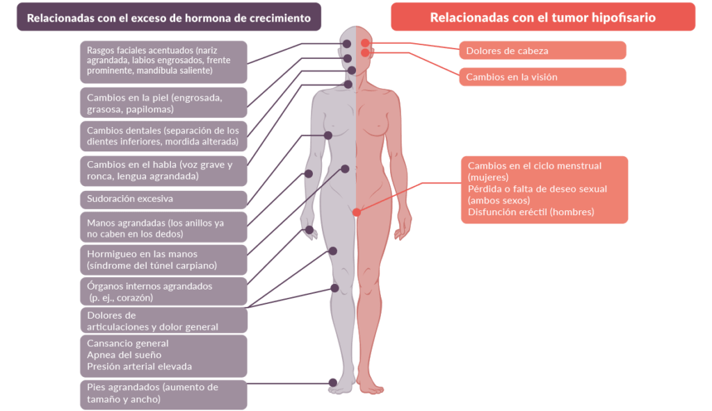 acromegalia causas sintomas y todo lo que necesitas saber