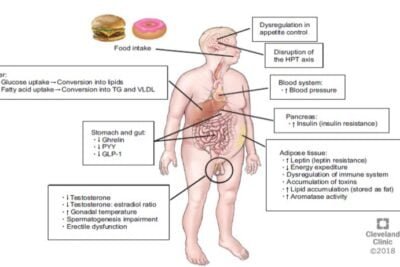 androgenos y su relacion con el sindrome metabolico