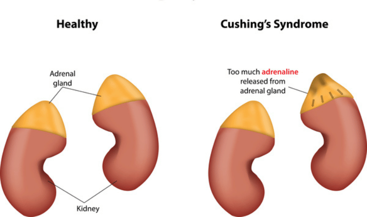 antecedentes familiares y su papel en el sindrome de cushing