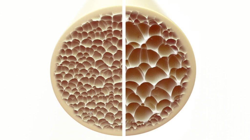 Avances recientes en investigaciones sobre osteoporosis 2023 1 avances recientes en investigaciones sobre osteoporosis 2023