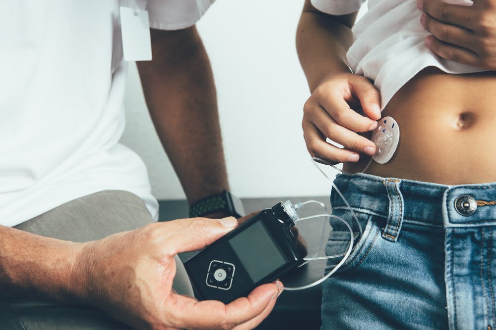 bombas de insulina mejora del control en la diabetes