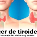 cancer de tiroides sintomas causas y que es la enfermedad