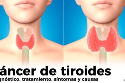 cancer de tiroides sintomas causas y que es la enfermedad