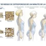 caracteristicas de los huesos afectados por osteoporosis