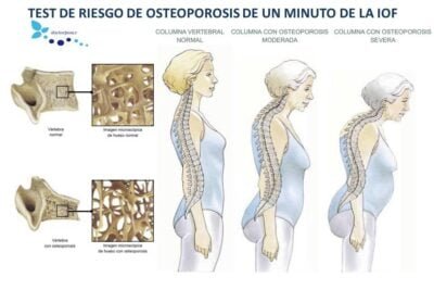 caracteristicas de los huesos afectados por osteoporosis