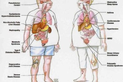 causas y efectos de trastornos glandulares y obesidad