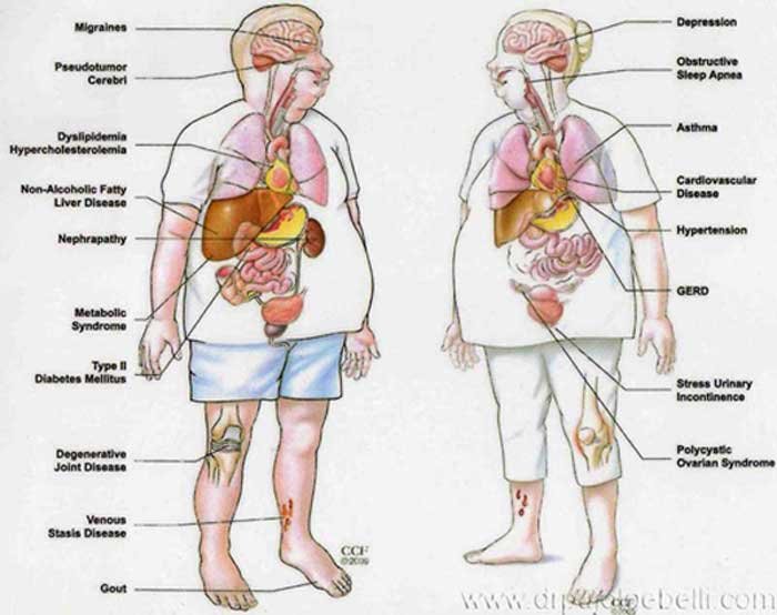 causas y efectos de trastornos glandulares y obesidad