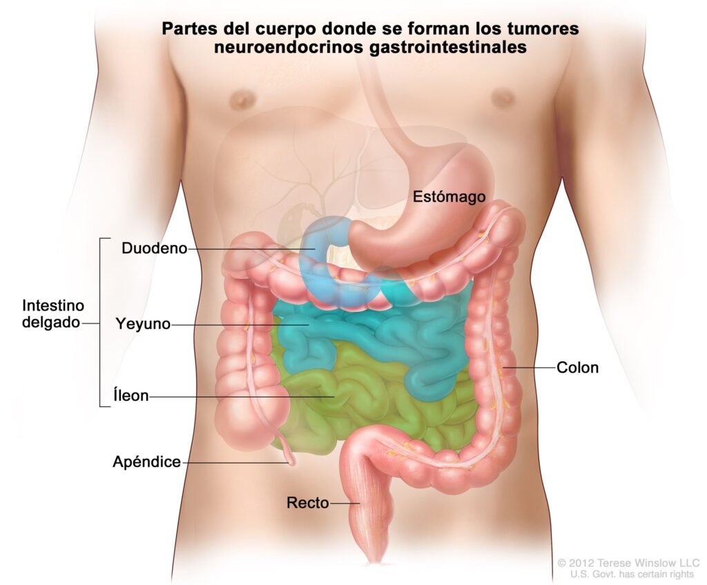 causas y factores de riesgo de tumores neuroendocrinos