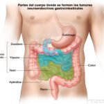 causas y factores de riesgo de tumores neuroendocrinos