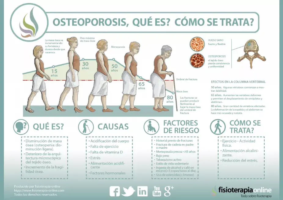 Clasificación, causas y tratamientos de la osteoporosis 1 clasificacion causas y tratamientos de la osteoporosis
