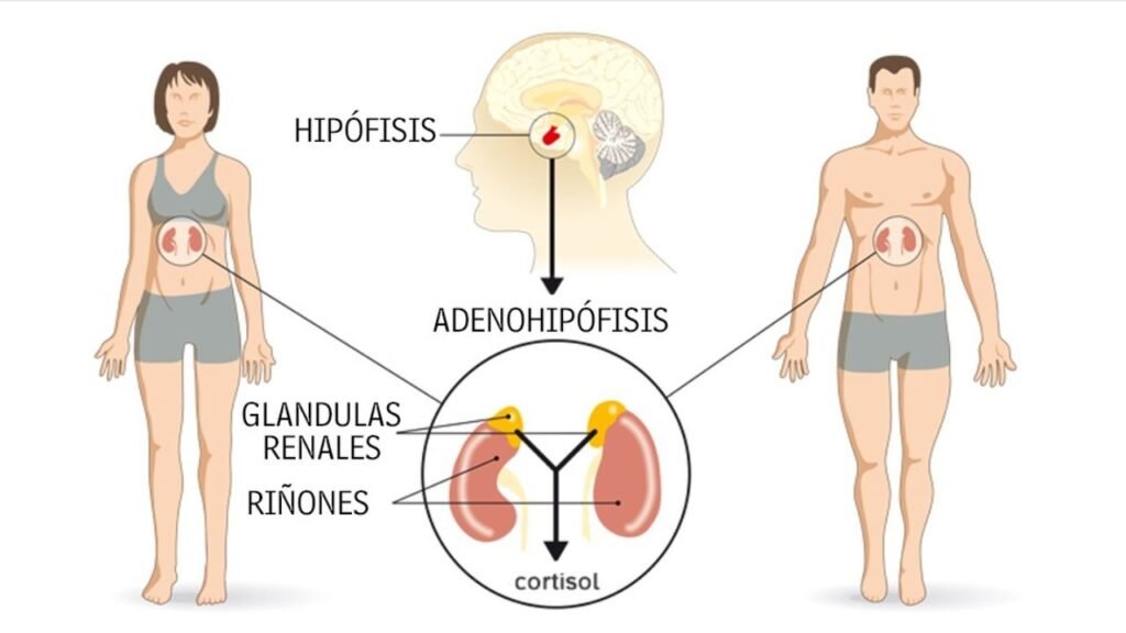 como afecta el sindrome de cushing a la calidad de vida