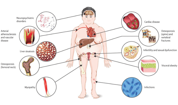 como afecta el sindrome de cushing a la salud mental