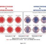 como afecta la hipoactividad a los niveles de energia