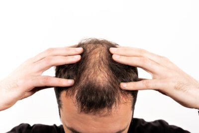 como afecta la testosterona a la piel y el cabello