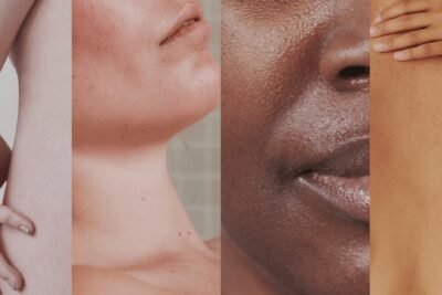 como afectan las hormonas a la salud de la piel