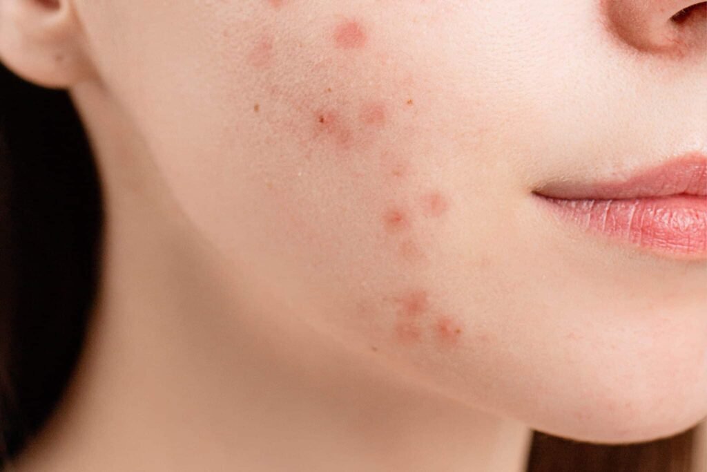 como influye el acne hormonal en la salud reproductiva