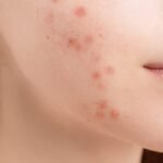 como influye el acne hormonal en la salud reproductiva