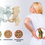 como pueden los estrogenos influir en la osteoporosis