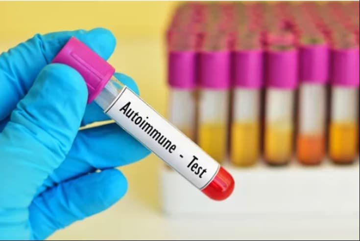 Cómo se diagnostican las enfermedades autoinmunes 1 como se diagnostican las enfermedades autoinmunes