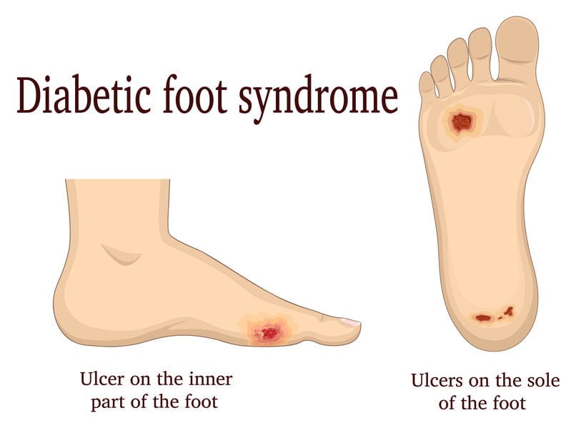 como se pueden proteger los pies de los diabeticos