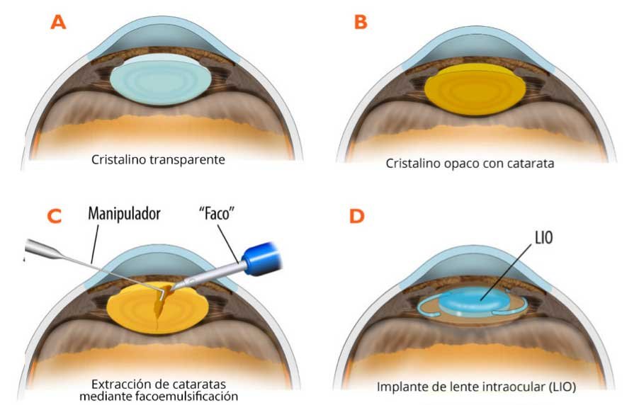 como se relaciona el eje hormonal con la salud ocular