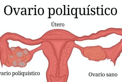 como se trata el sindrome del ovario poliquistico