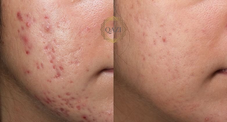 Conexión entre el acné y los andrógenos en la piel 1 conexion entre el acne y los androgenos en la piel