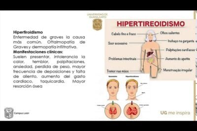crisis tiroidea sintomas esenciales que debes conocer