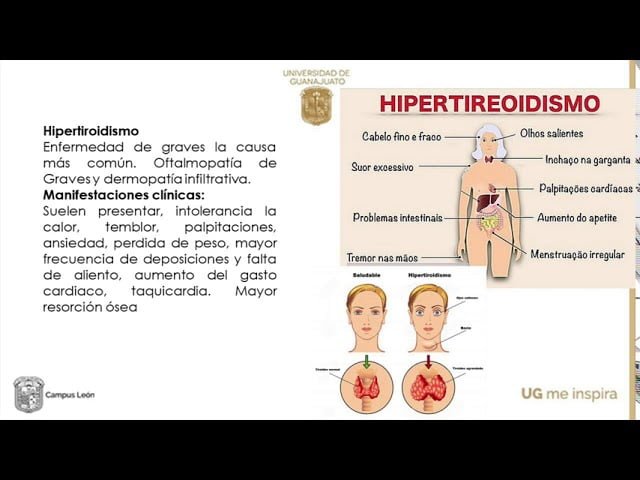 crisis tiroidea sintomas esenciales que debes conocer