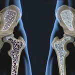 cuales son los mitos mas comunes sobre la osteoporosis