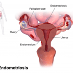 Disfunciones Hormonales: Causas y Exploración Profunda