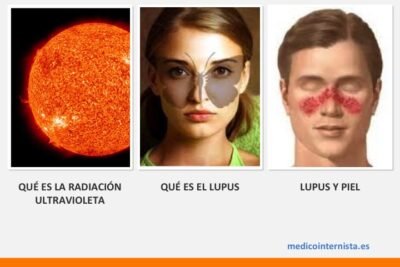 efectos del clima en personas con enfermedades autoinmunes