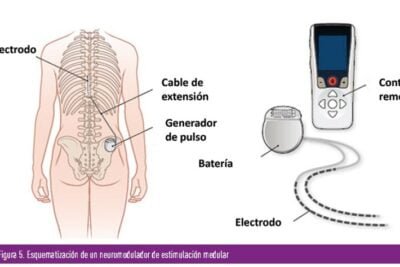 el papel de la insulina en la neuropatia y su tratamiento eficaz