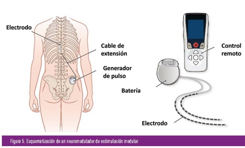 el papel de la insulina en la neuropatia y su tratamiento eficaz