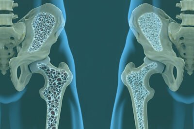 el papel de los estrogenos en la salud osea y la osteoporosis