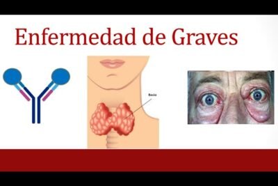 enfermedad de graves sintomas y tratamientos que debes conocer
