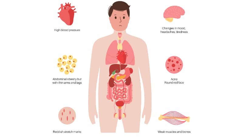 enfoques multidisciplinarios para tratar el sindrome de cushing