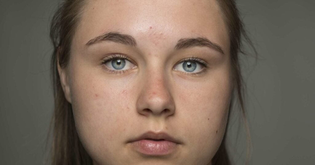 Estrógenos y acné en pieles jóvenes: lo que necesitas saber 1 estrogenos y acne en pieles jovenes lo que necesitas saber