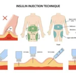 guia completa sobre la correcta administracion de insulina en diabeticos