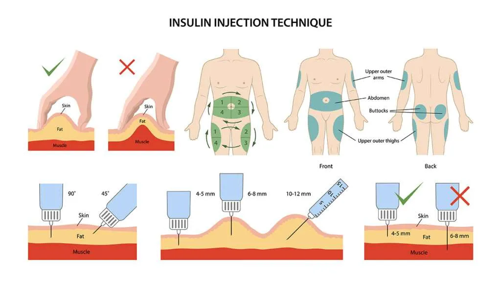 Guía completa sobre la correcta administración de insulina en diabéticos 1 guia completa sobre la correcta administracion de insulina en diabeticos
