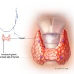 hiperparatiroidismo sintomas causas y definiciones clave