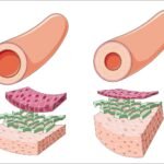 hipertension hereditaria causas y factores que influyen