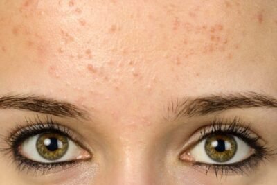 hormonas y acne causas efectos y tratamientos efectivos