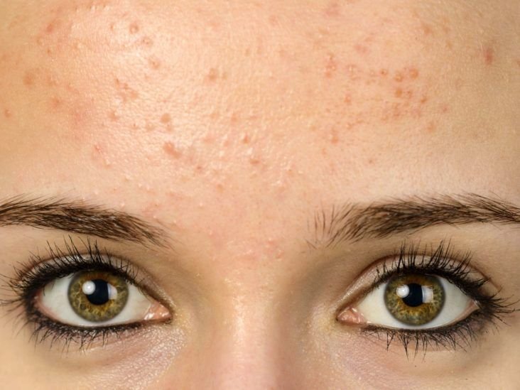 hormonas y acne causas efectos y tratamientos efectivos