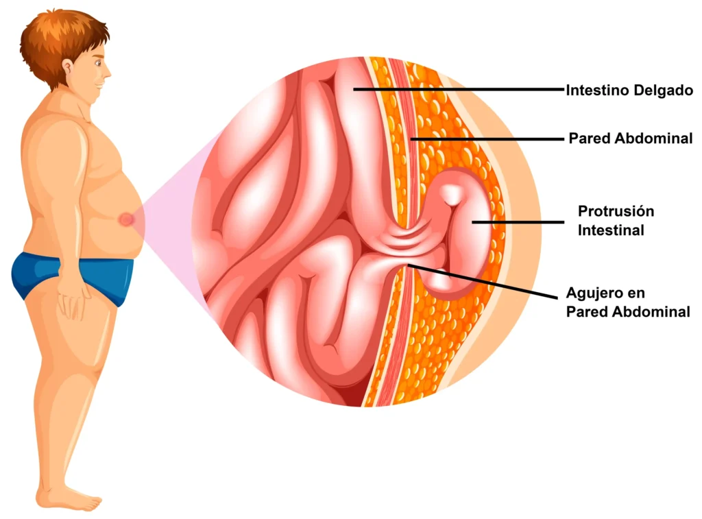 impacto de la obesidad en la salud intestinal consecuencias y soluciones