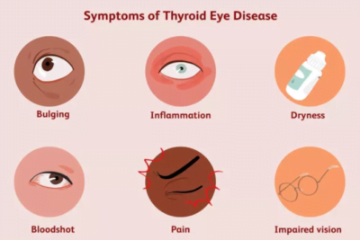 impacto de la tirotoxicosis en la salud ocular y la vision