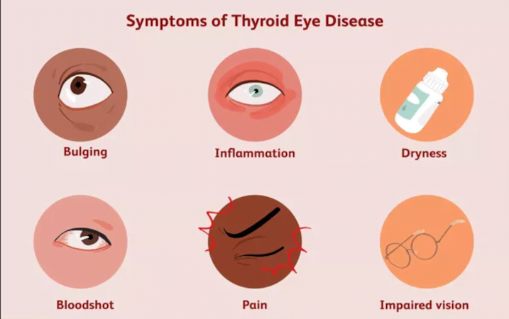 impacto de la tirotoxicosis en la salud ocular y la vision