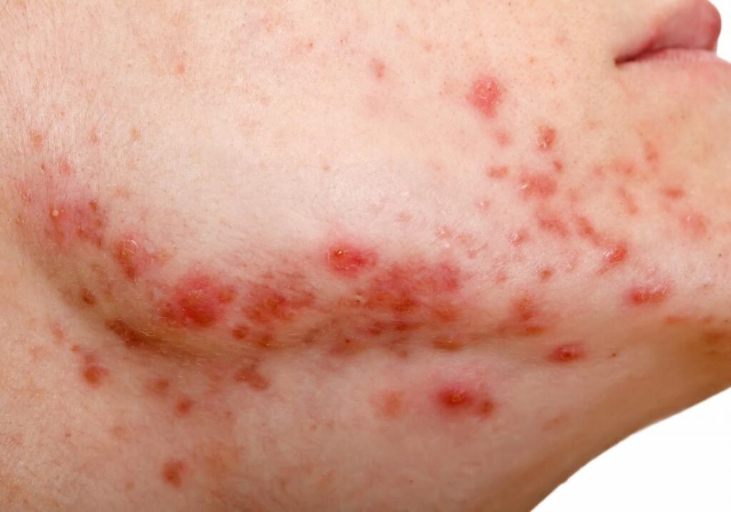 impacto de los cambios hormonales en la piel durante el acne