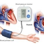 manejo de la hipertension en pacientes con trastornos hormonales