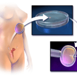 manipulacion hormonal en tratamientos de infertilidad como se hace